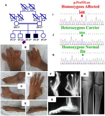 Biallelic Missense Mutation in the ECEL1 Underlies Distal Arthrogryposis Type 5 (DA5D)